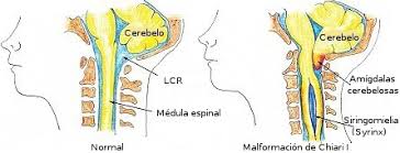 Resultado de imagen de SÃ­ndrome de Chiari