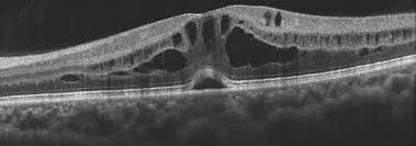cystoid macular edema louisville