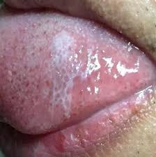 a white patch on the tongue the bmj