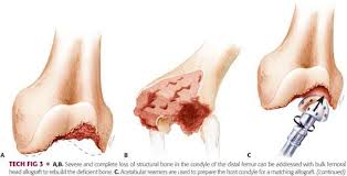 total knee arthroplasty with fem