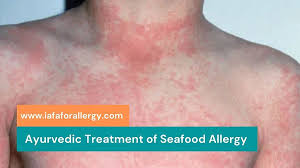 seafood allergy causes symptoms and