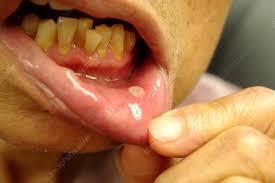 canker sores stock image c022 1882