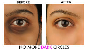 get rid of undereye dark circles bags