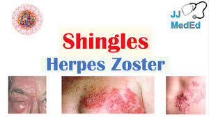 shingles herpes zoster
