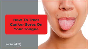 treat canker sores on your tongue