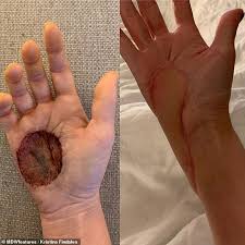 There is a type of melanoma called acral lentiginous melanoma which is more common for people with dark skin. Mother S Itchy Birthmark That Lost Colour Turned Out Be Skin Cancer Sound Health And Lasting Wealth