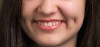 get dimples naturally without surgery