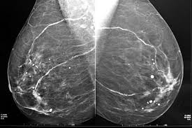 Resultado de imagen para mamografÃ­a