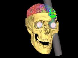 Phineas Gage   Wikipedia 