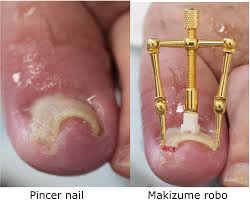 treat ingrown nail and pincer nail