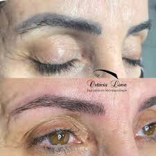 How to surgically remove your tattoo. Microblading Removal When And How To Do It Pmuhub