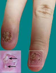 an unusual presentation of psoriasis