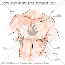 Holter Heart Monitor Lead Placement Chart Gl Stock Images