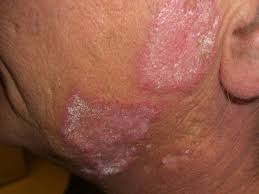 lupus rash what it is and how to treat