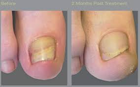 laser toenail fungus treatment austin