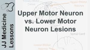 upper and lower motor neuron lesions
