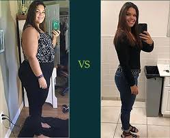 before and after gallery bariatric