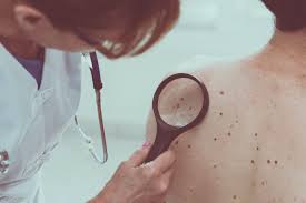 6 kinds of skin cancer and their symptoms