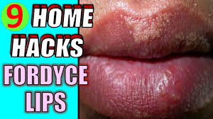 home remes for fordyce spots on lips