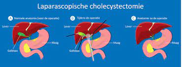 Cholecystectomie (Folder) - Catharina Ziekenhuis