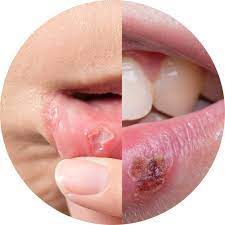 cold sore or canker sore total care