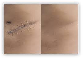 micropigmentation tattoo skin treatment