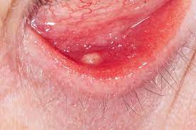 meibomian cyst in the lower eyelid