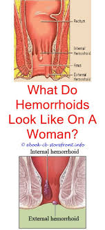 Hemorrhoids may be located just. 19 Enticing Hemorrhoid Types Of Ideas