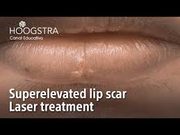 superelevated lip scar laser