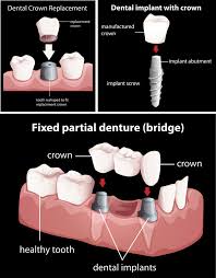 dental bridges smiles by german design