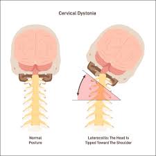 cervical dystonia causes risk factors