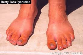 rusty shoes and toes syndrome bygl