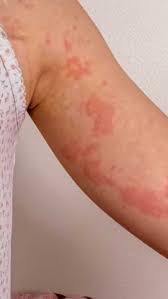 home remes to get rid of winter rashes