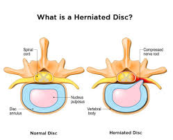 8 tips to avoid a herniated disc