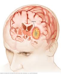 Glioma Symptoms And Causes Mayo Clinic