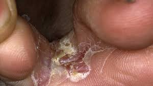 fungal infections types symptoms and
