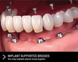 dental bridge over a dental implant