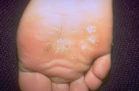 types of warts and how to treat them
