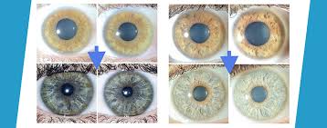 eye color change with keratopigmentation