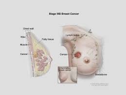 Triple negative and other types of breast cancer stages include: Breast Cancer Stages Stage 0 4 Breast Cancer Osuccc James