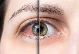 5 serious causes of red eyes luis c