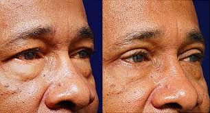 Before after pictures of eye surgery at jw beauty clinic in seoul, south korea. Nip And Tuck Plastic Surgery For Men