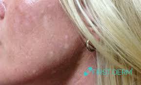 white spots on skin pictures causes