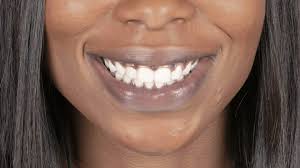 black gums and spots on gums causes