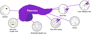 It's usually caught only when it becomes large and. Symptoms Of Pancreatic Cancer Managing Pancreatic Cancer Let S Win