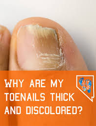 thick discolored toenails absolute