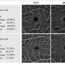 exle images of vascular density in