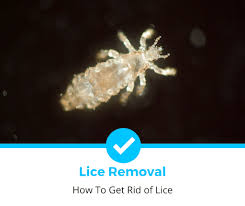 how to get rid of lice 2023 edition