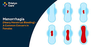 menorrhagia heavy menstrual bleeding