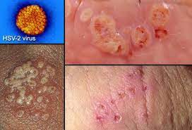 The herpes simplex virus, also known as hsv, is an infection that causes herpes. Herpes Simplex Virus Type 2 Picture Image On Medicinenet Com